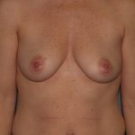 Breast Augmentation Before & After Patient #2829