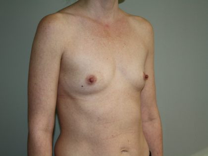 Breast Augmentation Before & After Patient #2850