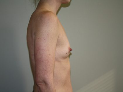 Breast Augmentation Before & After Patient #2850