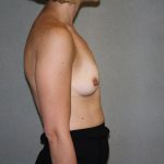 Breast Augmentation Before & After Patient #2878