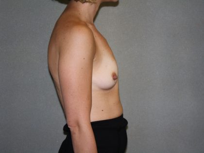 Breast Augmentation Before & After Patient #2878