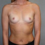 Breast Augmentation Before & After Patient #2899
