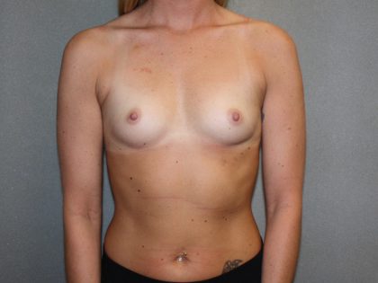 Breast Augmentation Before & After Patient #2899