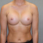 Breast Augmentation Before & After Patient #2899