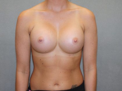 Breast Augmentation Before & After Patient #2899