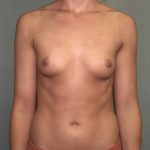 Breast Augmentation Before & After Patient #2906