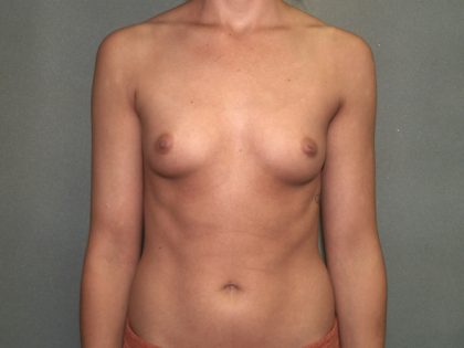 Breast Augmentation Before & After Patient #2906