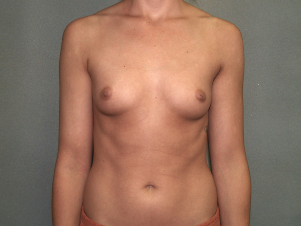 Breast Augmentation Before & After Patient #2906