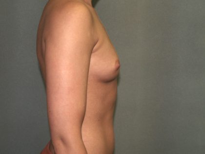 Breast Augmentation Before & After Patient #2906