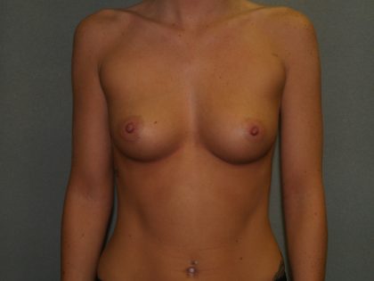 Breast Augmentation Before & After Patient #3018