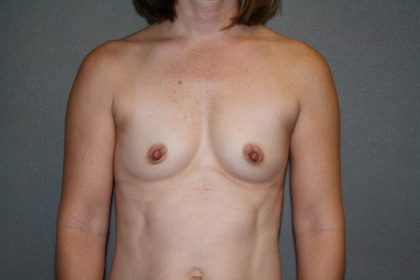 Breast Augmentation Before & After Patient #3004