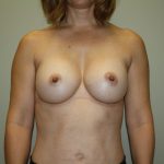 Breast Augmentation Before & After Patient #3004