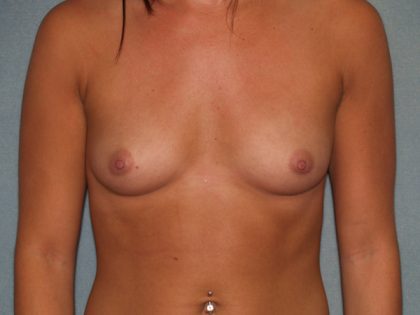 Breast Augmentation Before & After Patient #3039