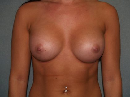 Breast Augmentation Before & After Patient #3039