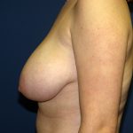 Breast Reduction Before & After Patient #3426