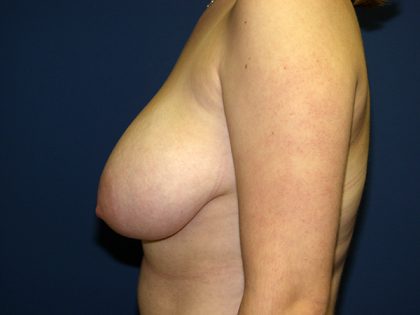 Breast Reduction Before & After Patient #3426