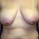 Breast Reduction Before & After Patient #3426