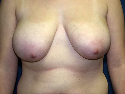 Breast Reduction Before & After Patient #3426