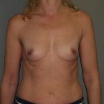 Breast Augmentation Before & After Patient #3109