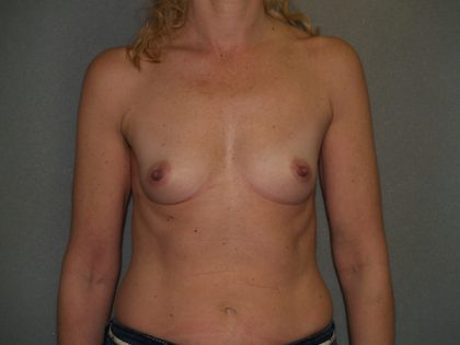 Breast Augmentation Before & After Patient #3109