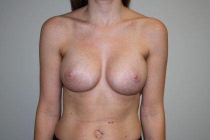 Breast Augmentation Before & After Patient #3116