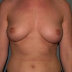 Breast Augmentation Before & After Patient #3139