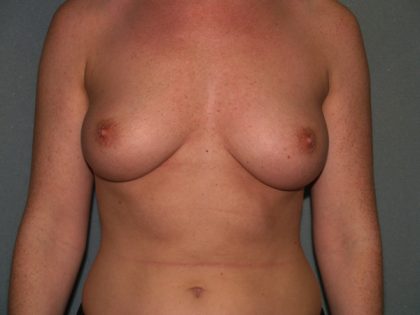 Breast Augmentation Before & After Patient #3139