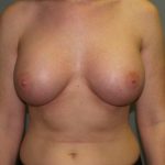 Breast Augmentation Before & After Patient #3139
