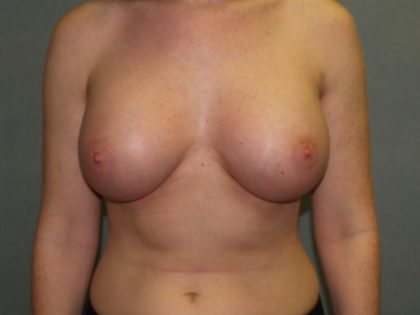 Breast Augmentation Before & After Patient #3139