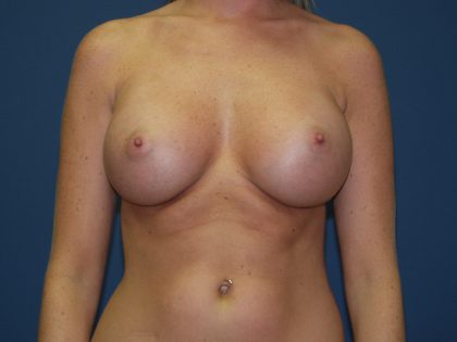 Breast Augmentation Before & After Patient #3132