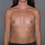 Breast Augmentation Before & After Patient #3201