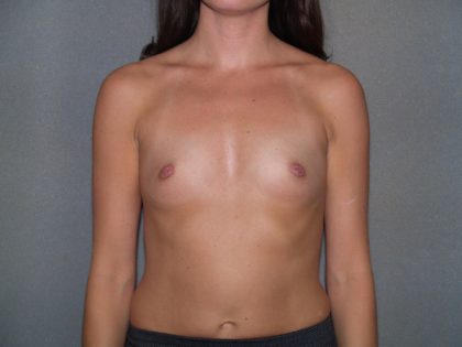 Breast Augmentation Before & After Patient #3201