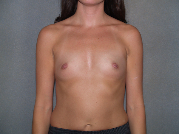 Breast Augmentation Before & After Patient #3201