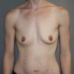 Breast Augmentation Before & After Patient #3229