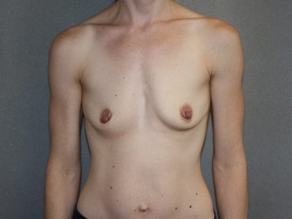 Breast Augmentation Before & After Patient #3229