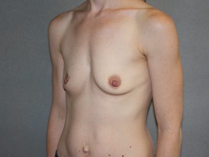 Breast Augmentation Before & After Patient #3229