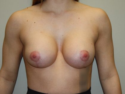 Breast Lift with Implant Before & After Patient #1446