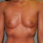 Breast Augmentation Before & After Patient #3236