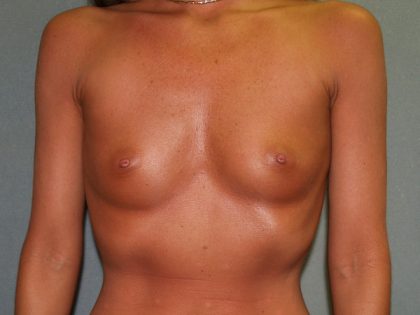 Breast Augmentation Before & After Patient #3236