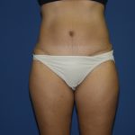 Tummy Tuck Before & After Patient #1848