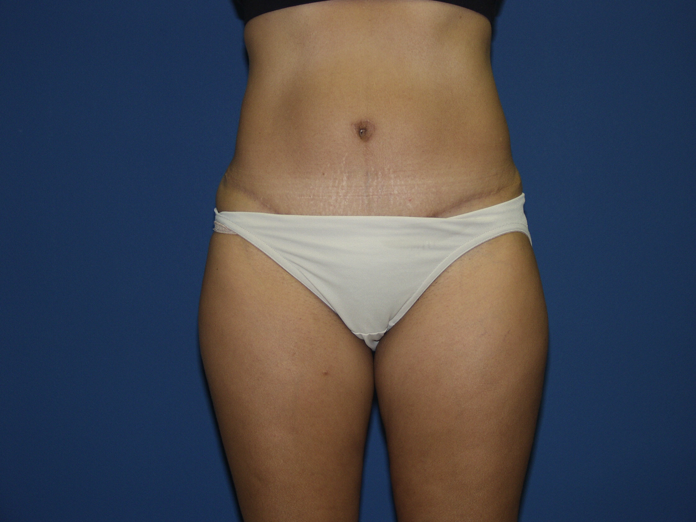Tummy Tuck Before & After Patient #1848