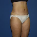 Tummy Tuck Before & After Patient #1848