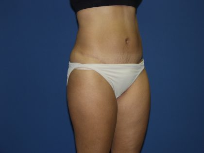 Tummy Tuck Before & After Patient #1848