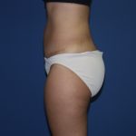 Tummy Tuck Before & After Patient #1848