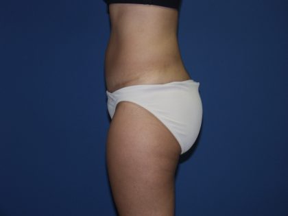 Tummy Tuck Before & After Patient #1848