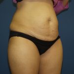 Tummy Tuck Before & After Patient #1848