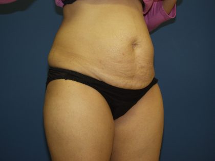 Tummy Tuck Before & After Patient #1848