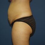 Tummy Tuck Before & After Patient #1848