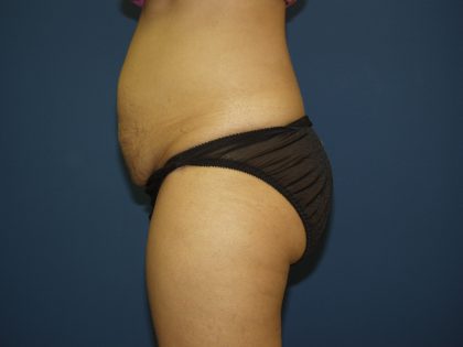 Tummy Tuck Before & After Patient #1848