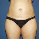 Tummy Tuck Before & After Patient #1848